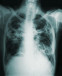 Pioneering Point of Care Diagnostic Test for Tuberculosis